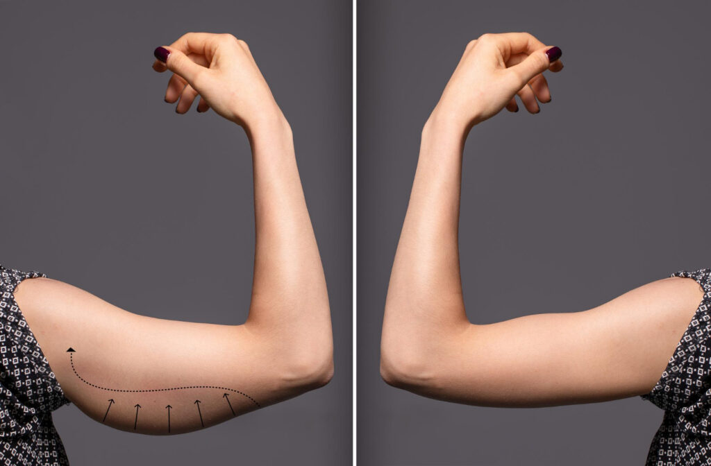 A woman 's arm before and after surgery.